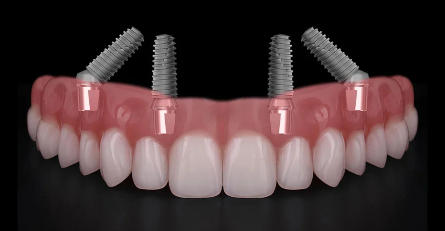 All on 4 Dental Implants Step by Step Inblog